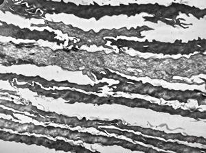 M, 60y. | superficial epidermal cells - lentigo M, 60y. | superficial epidermal cells - lentigo